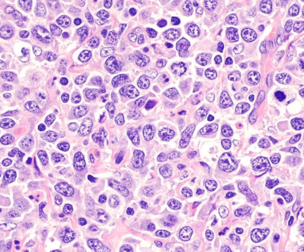 Breakthrough gives hope in fight against aggressive form of blood cancer