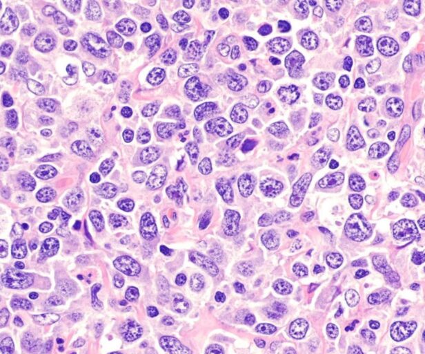 Breakthrough gives hope in fight against aggressive form of blood cancer